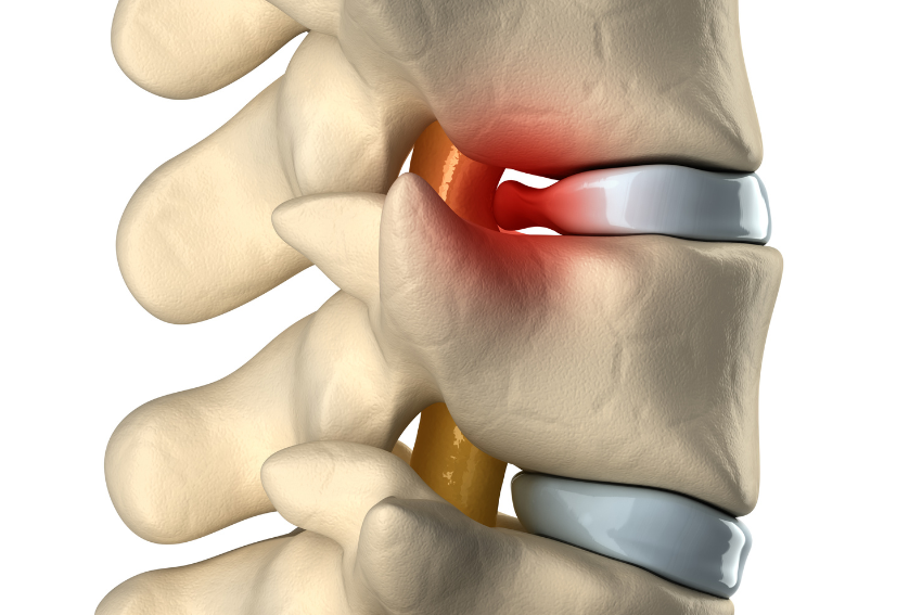 Chiropractic Services for a Herniated Disk